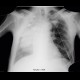 Pneumothorax, fluidopneumothorax, pleural drainage: X-ray - Plain radiograph